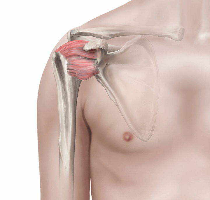 Illustration of inflammation that causes a frozen shoulder.