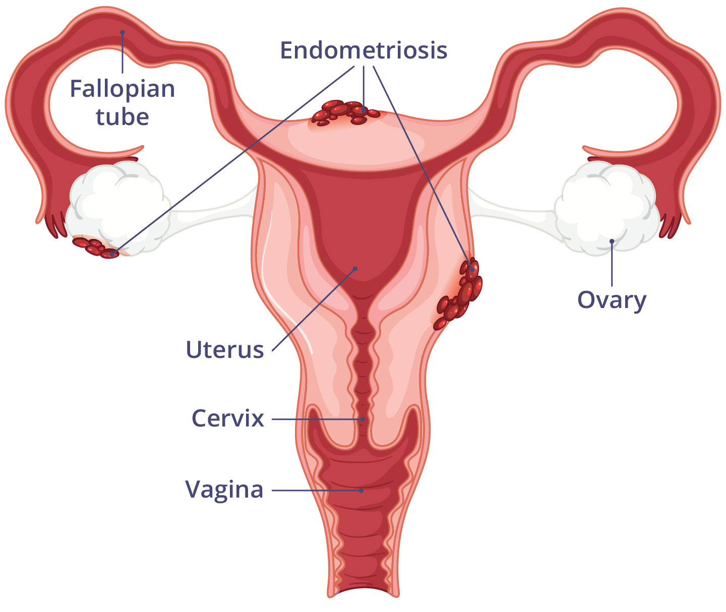 Illustration showing endometriosis occurring outside of the uterus.