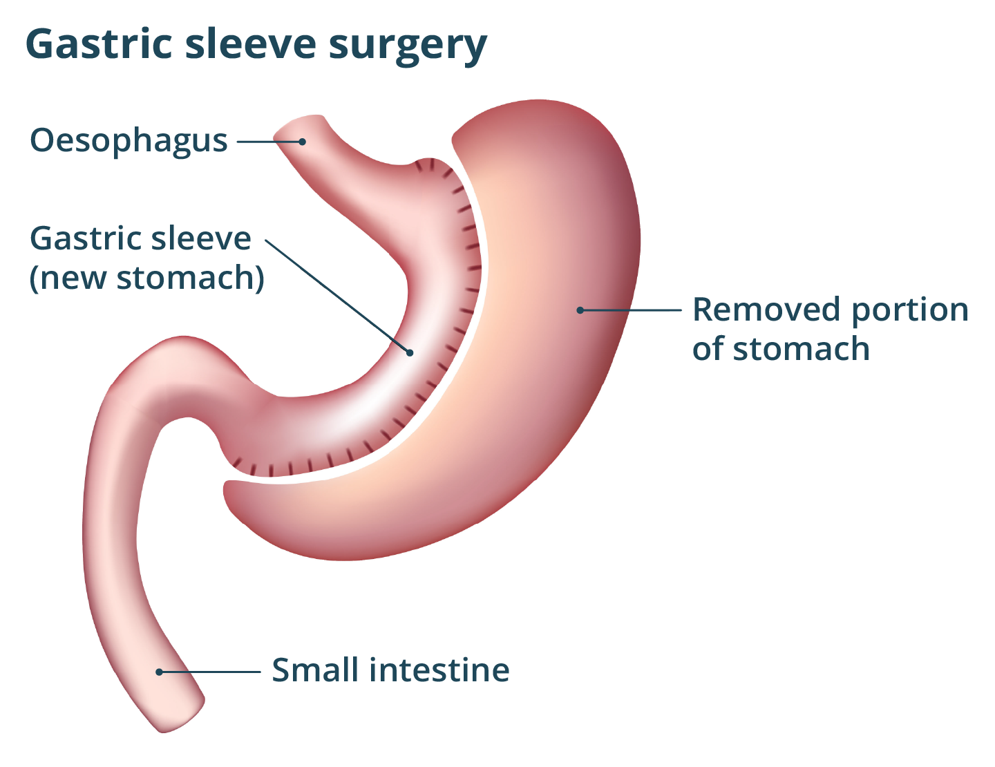 illustration of a gastric sleeve