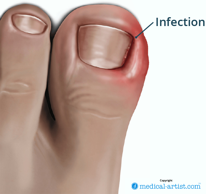 Illustration showing an ingrowing toenail (adult).