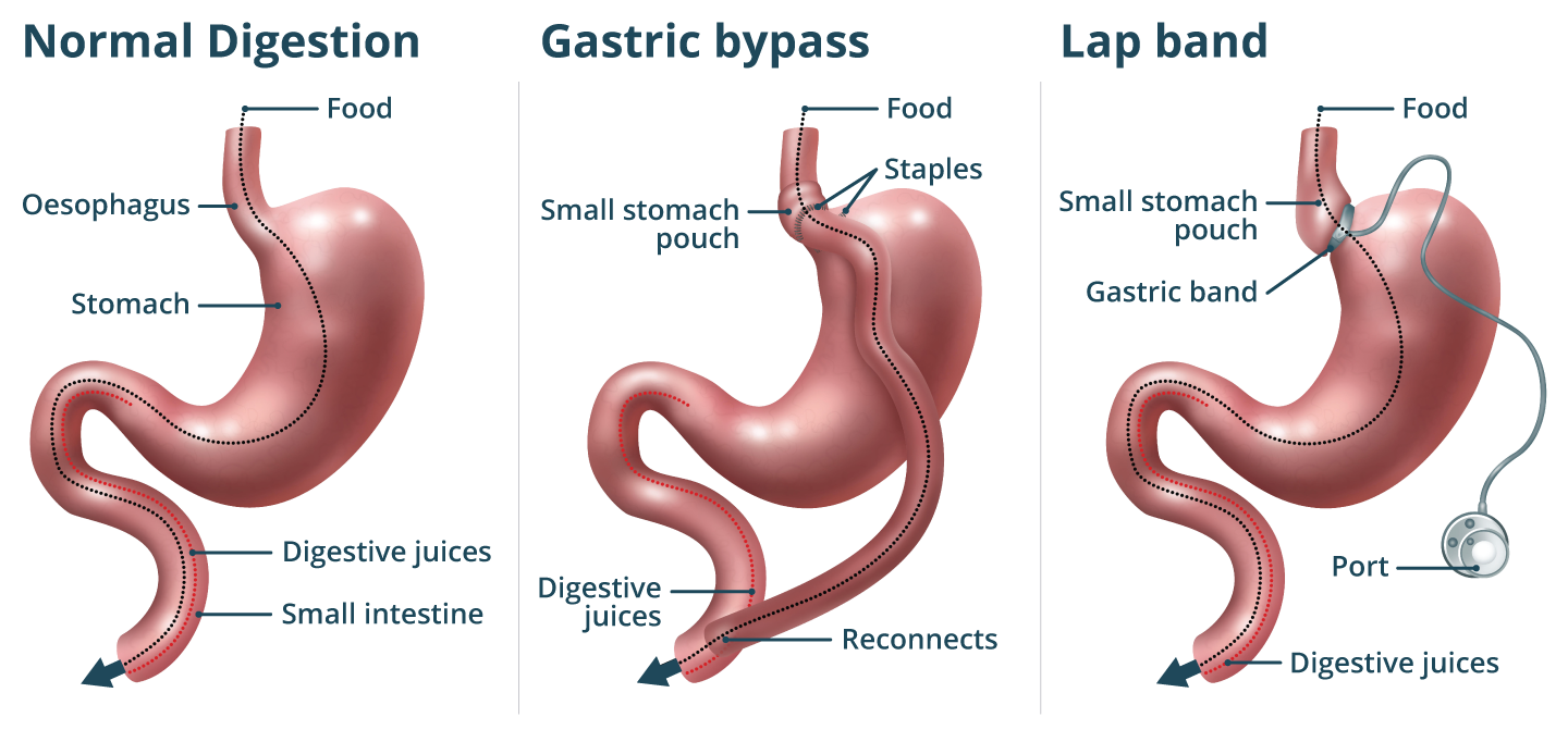 Bariatric surgery Illustration of a normal digestive system next to one with gastric bypass and another with lap band.