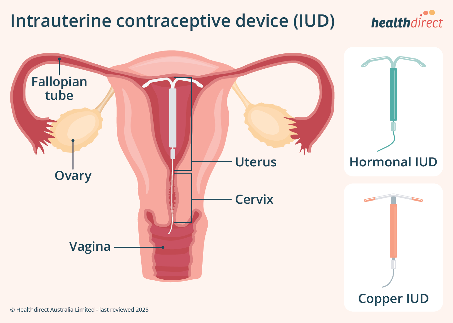 Mirena Iud Stuck In Cervix Mirena Iud Stuck In Cervix