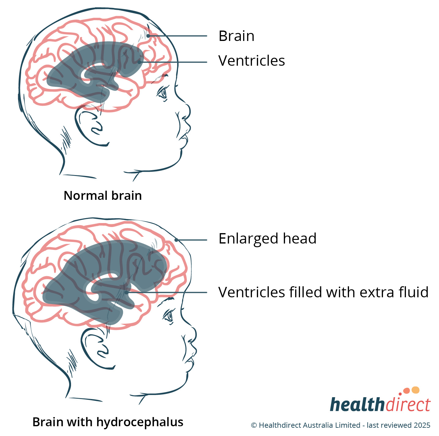 Consequences Of Hydrocephalus