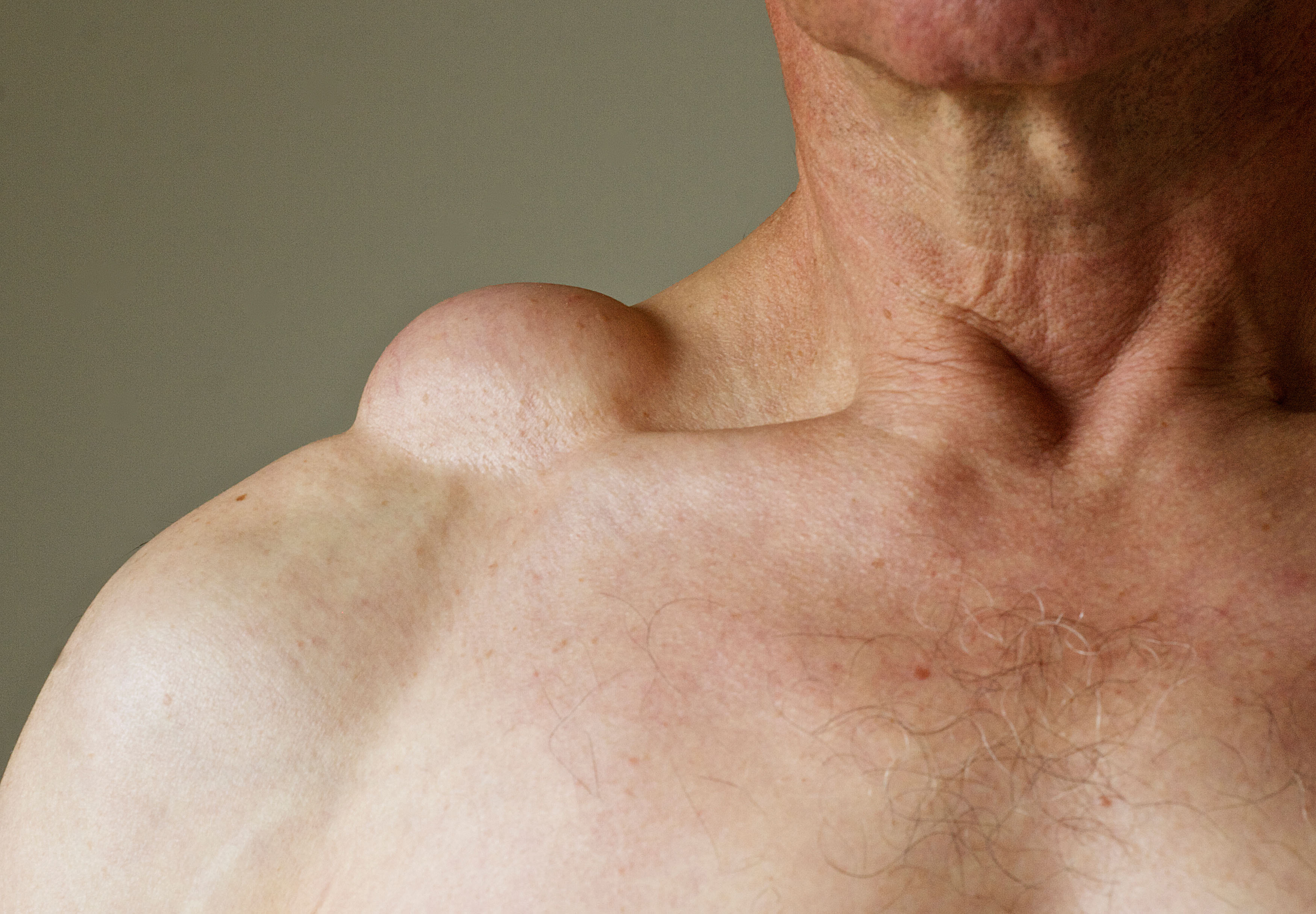 Picture of a lipoma lump on a person's shoulder.