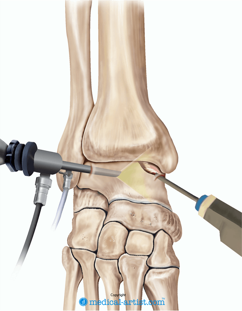 Illustration of an arthroscopy of the ankle.