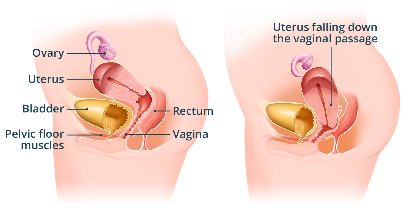 Illustration showing a normal uterus position, next to a prolapsed uterus that has dropped downward into the vaginal canal.