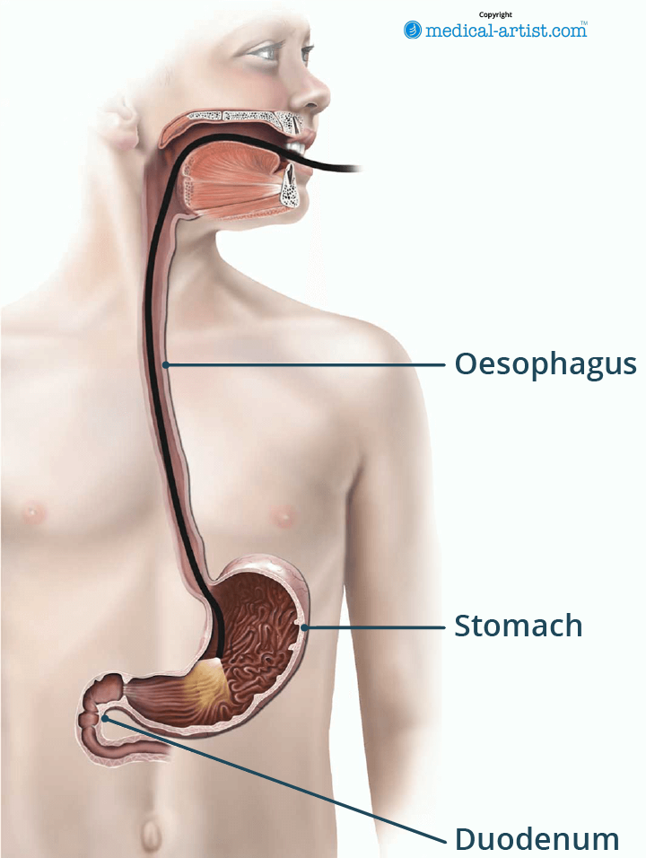 Illustration showing an upper GI endoscopy.