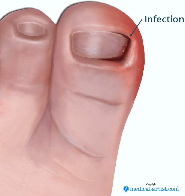 Illustration showing an ingrown toenail.