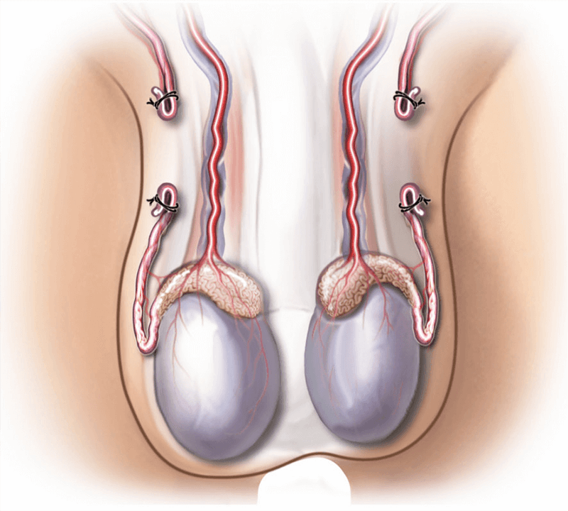 Vasectomy Reversal: Cost, Success, Sperm Post-Op