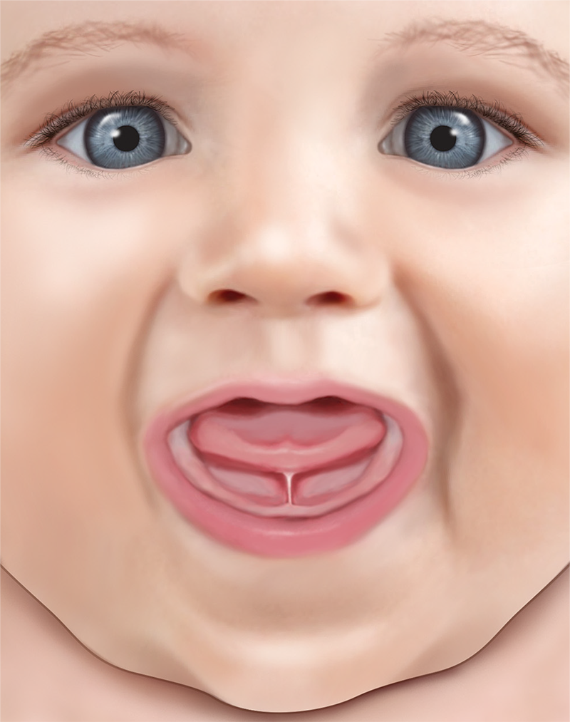 Tongue-tie division (infant)