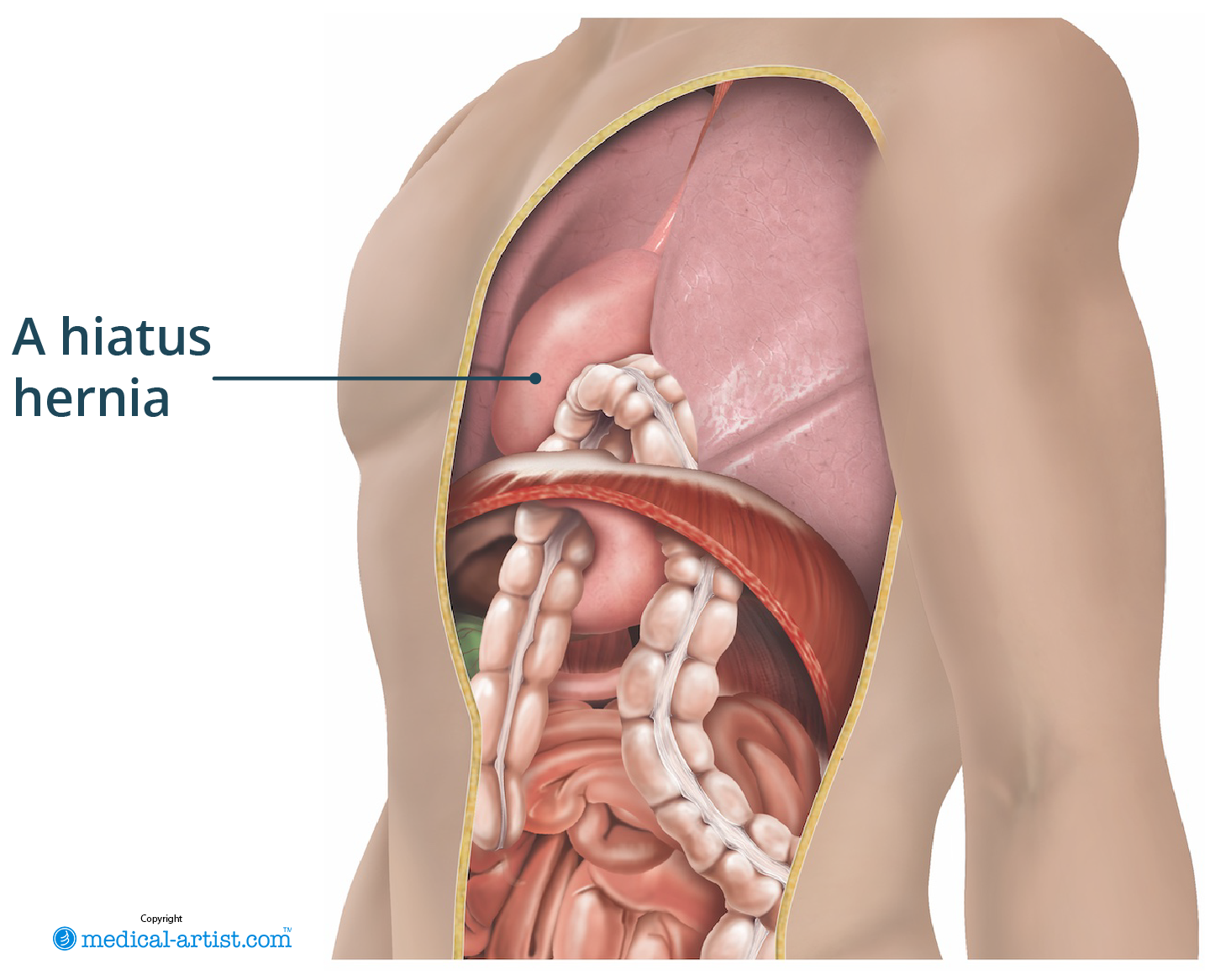 Illustration showing a hiatus hernia.