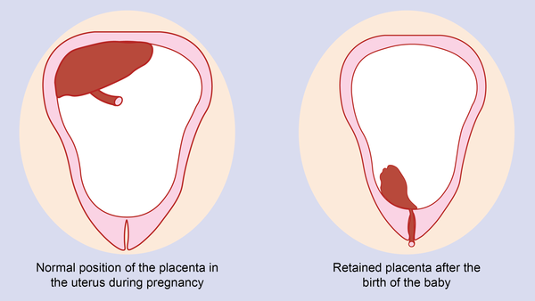 Postpartum Sexual Activity