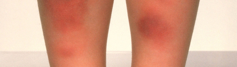 Erythema nodosum shows as a lumpy red rash, usually on the lower legs. Erythema nodosum shows as a lumpy red rash, usually on the lower legs.