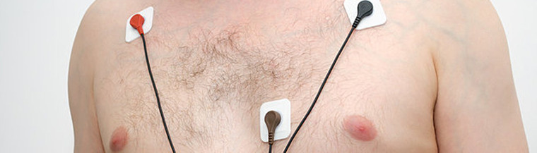 Tachycardia is an abnormal type of heart rhythm Tachycardia is an abnormal type of heart rhythm