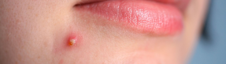 Acne Acne