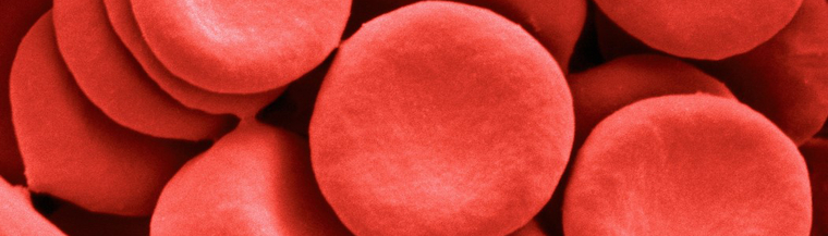 Haemochromatosis is an inherited condition that causes the body to absorb too much iron. Haemochromatosis is an inherited condition that causes the body to absorb too much iron.