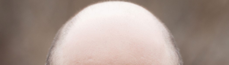 Male-pattern baldness. Male-pattern baldness.