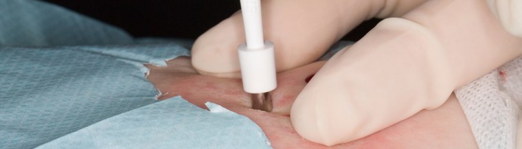 Biopsy involves taking a small piece of tissue from the body. Biopsy involves taking a small piece of tissue from the body.