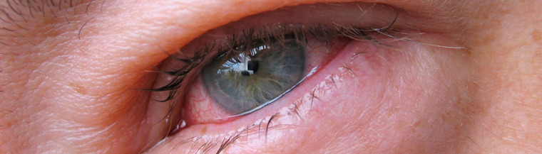 Uveitis usually causes a red painful eye. Uveitis usually causes a red painful eye.