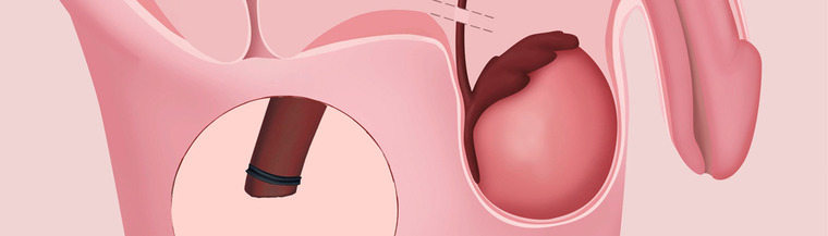 A vasectomy cuts the vas deferens, which are the tubes that carry sperm from the testes to the penis. A vasectomy cuts the vas deferens, which are the tubes that carry sperm from the testes to the penis.