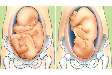 Breech Pregnancy Pregnancy Birth And Baby