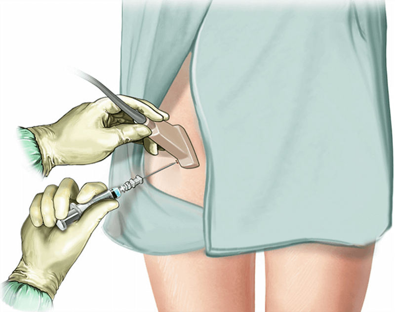 Peripheral Nerve Block lower Limb Healthdirect