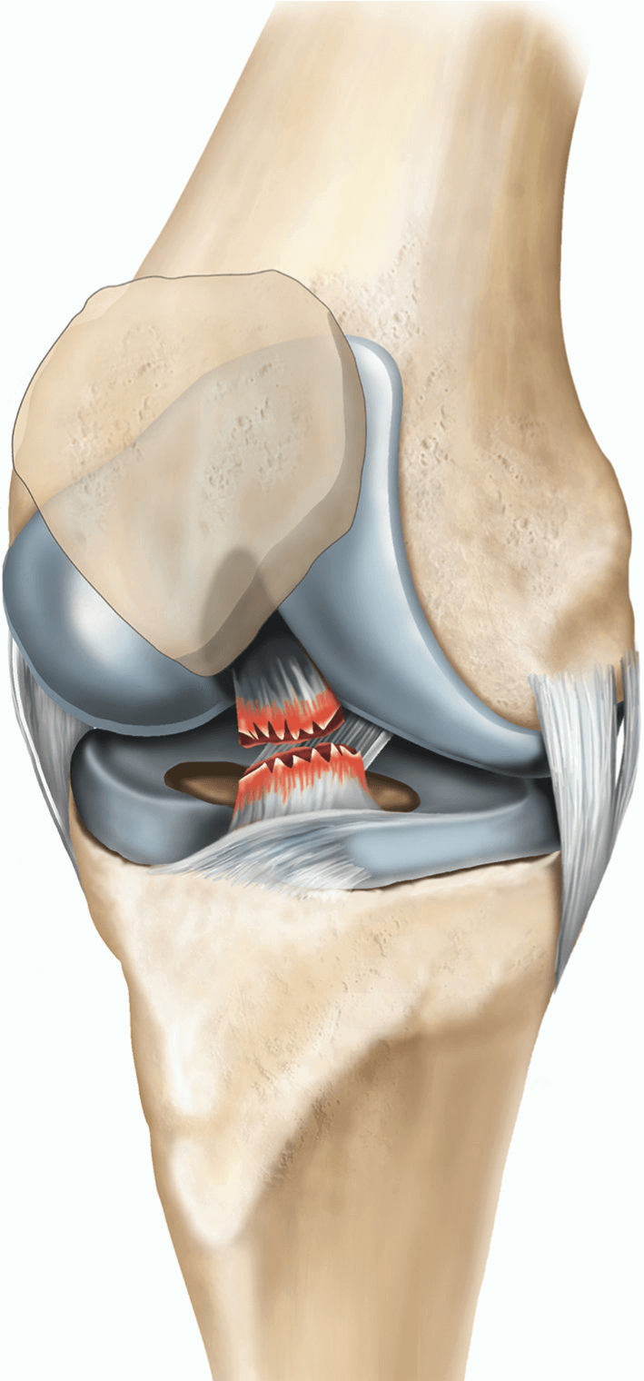 Illustration of a torn ACL.