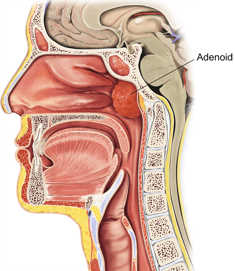 enlarged adenoid