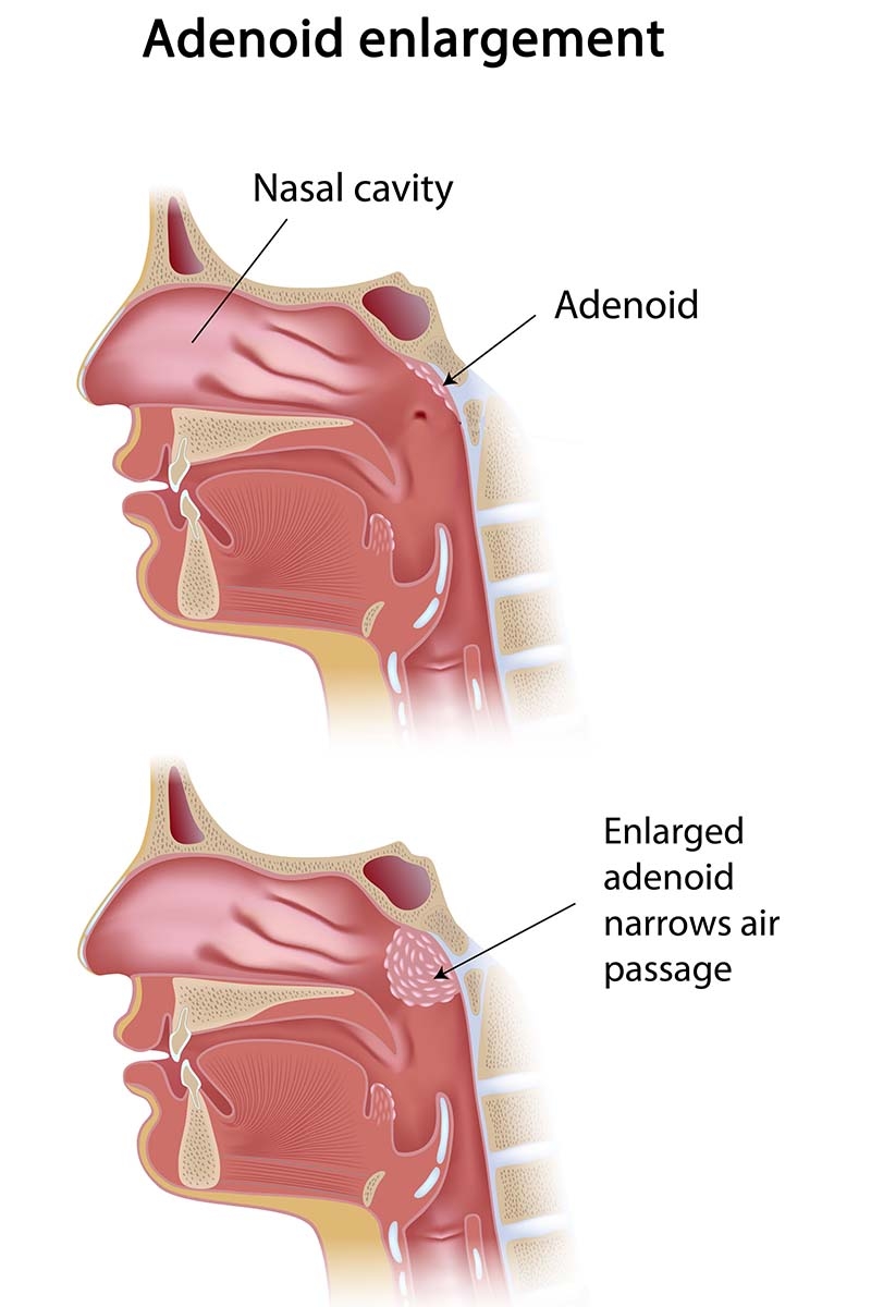 illustration of enlarged adenoid