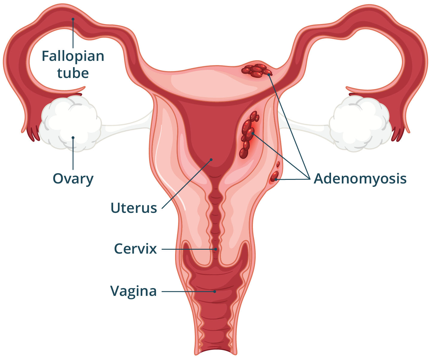 Illustration of the female reproductive system with adenomyosis in the muscle layer of the uterus.