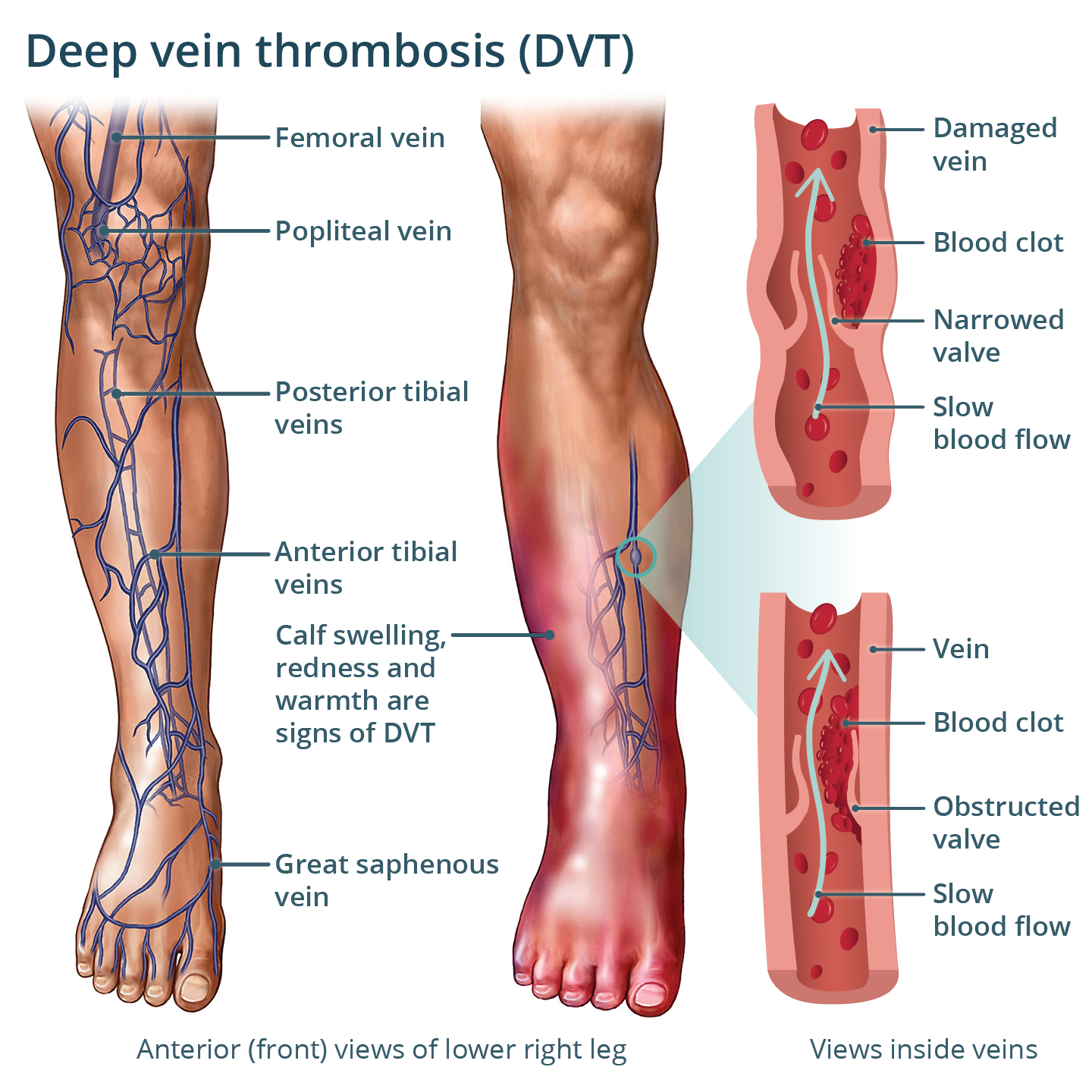 An illustration showing deep vein thrombosis.