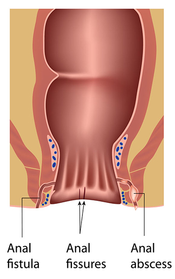 Passed Out Drunk First Anal Video - Anal fissure - symptoms, causes, and treatments | healthdirect