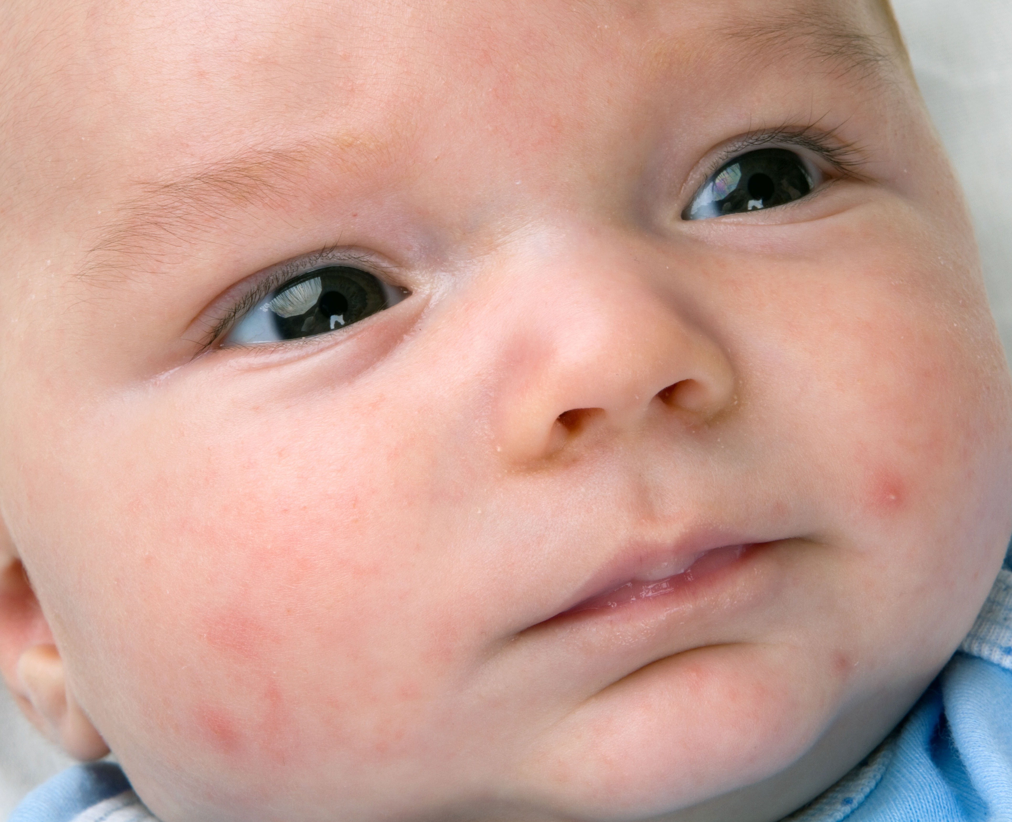 An image of a baby with acne.