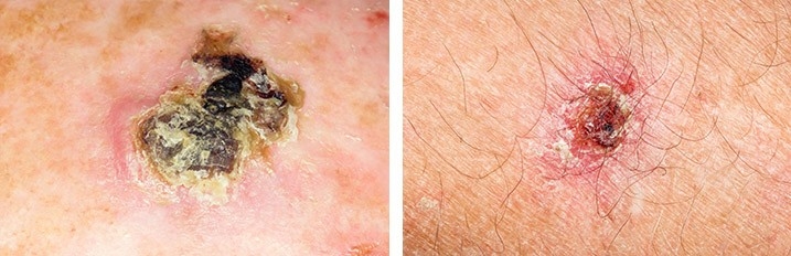 Image showing two examples of basal cell carcinoma.