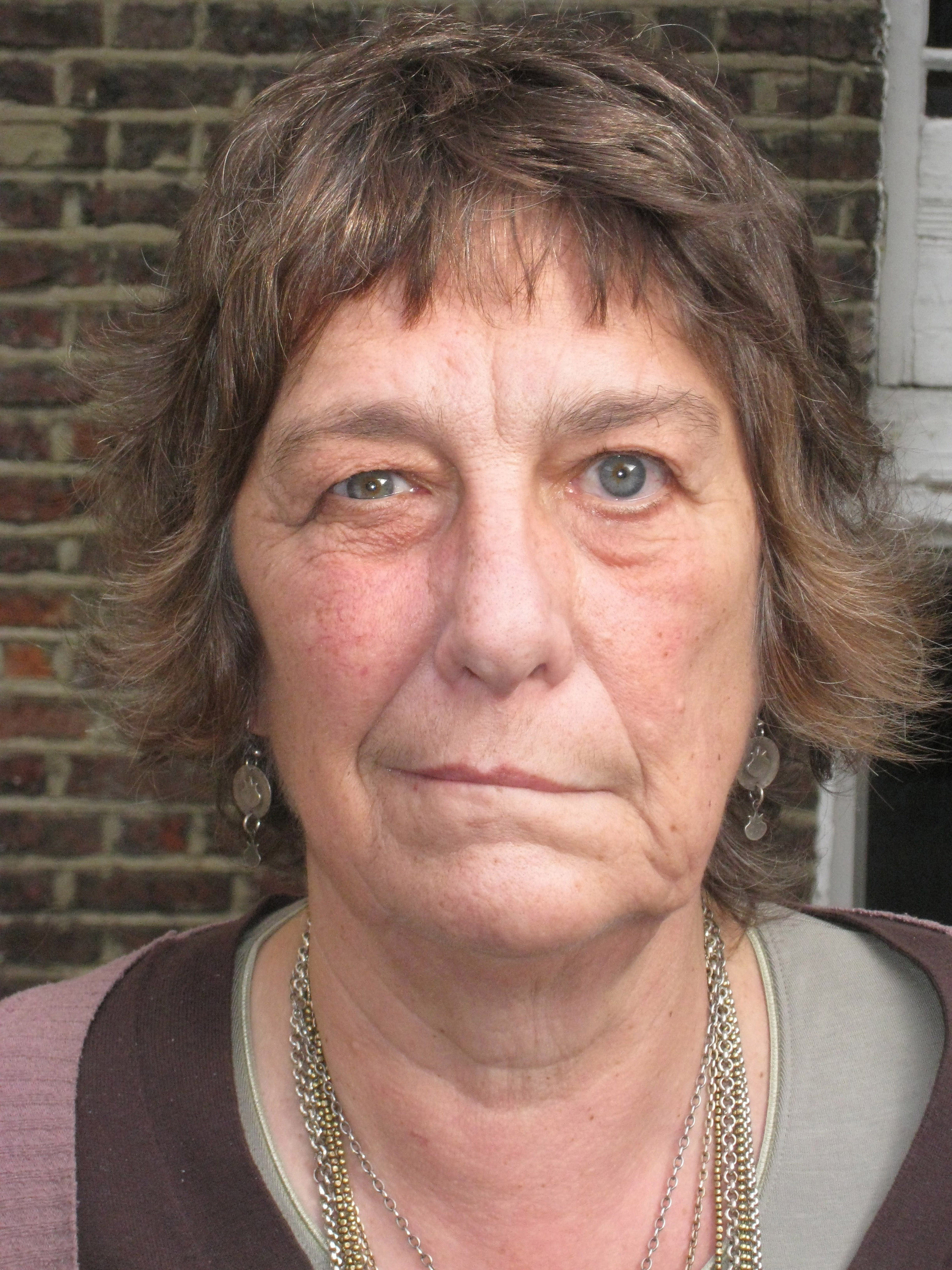 An example of Bell's palsy