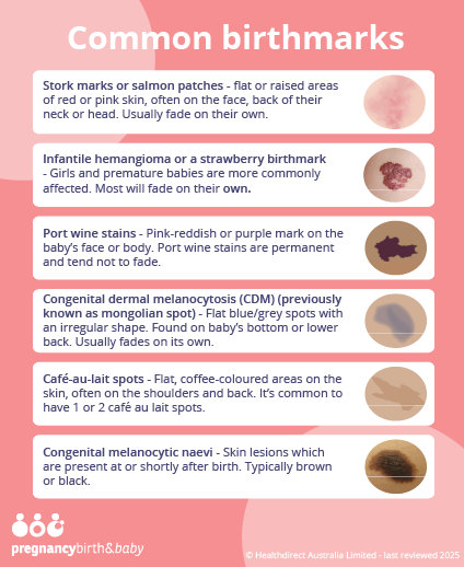 Image title Common birthmarks.