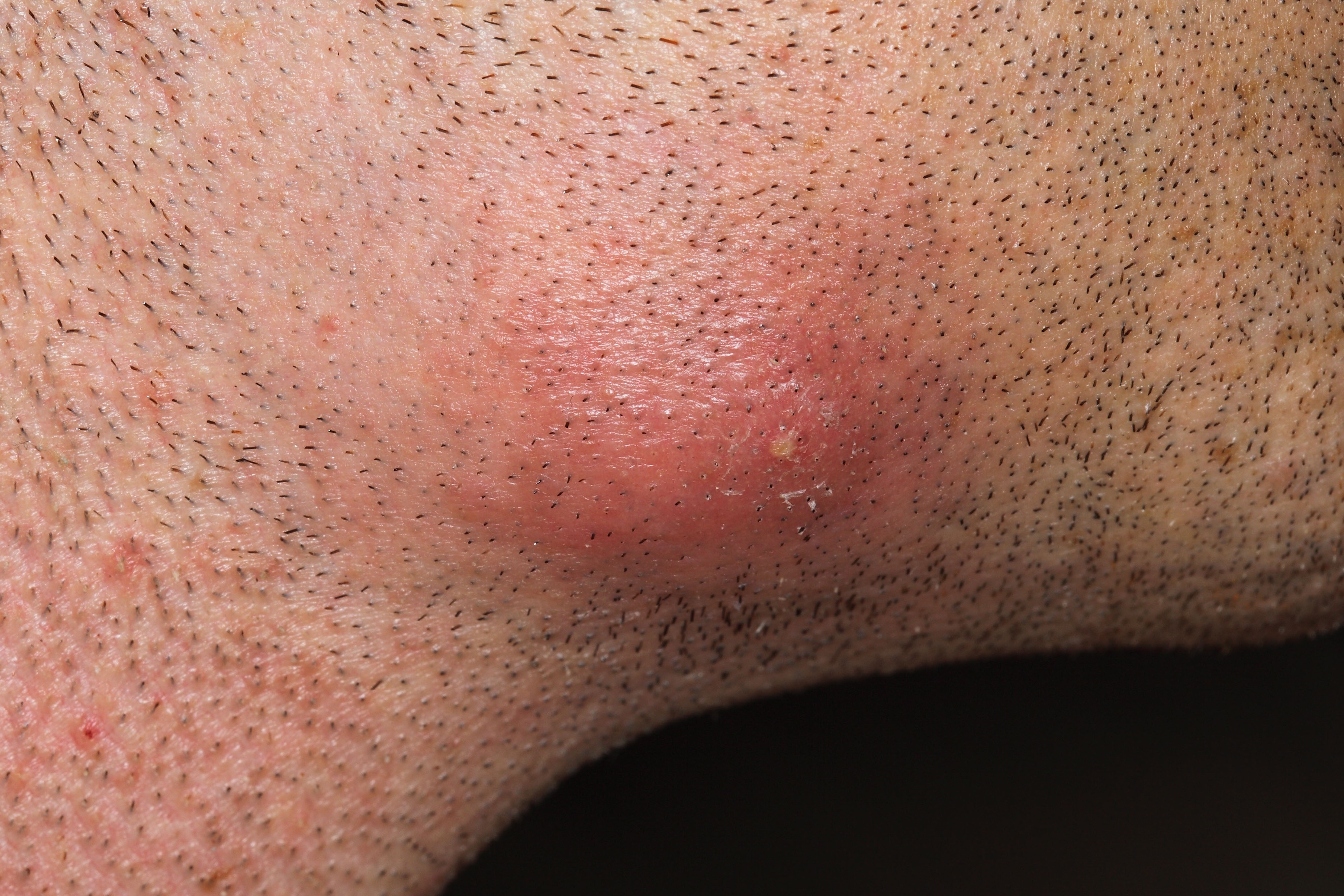 Boils Symptoms Causes And Treatment Healthdirect