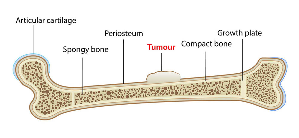 Illustration of primary bone cancer, which is sometimes called ‘osteosarcoma’ or ‘bone sarcoma’.