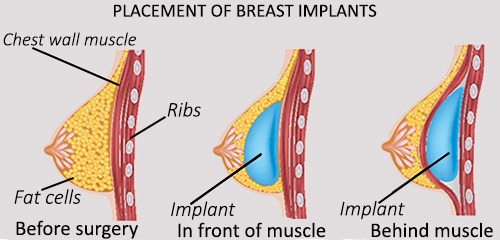 overweight and wanting breast implants