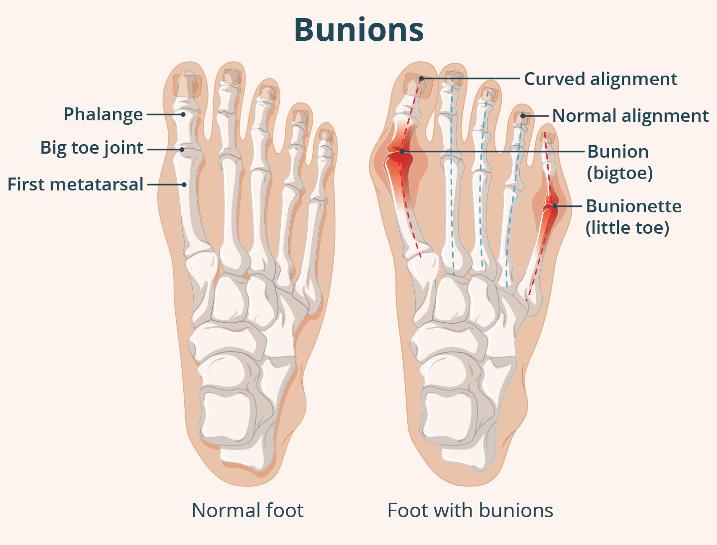 Illustration comparing a normal foot and a foot with bunions, showing curvature of the big toe and little toe bones.
