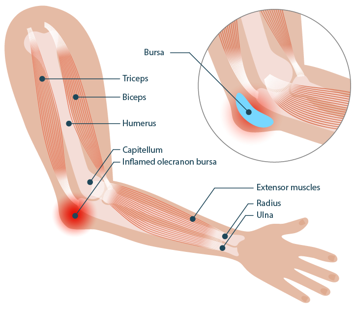 A diagram of a human arm showing the location of the bursa in the elbow.