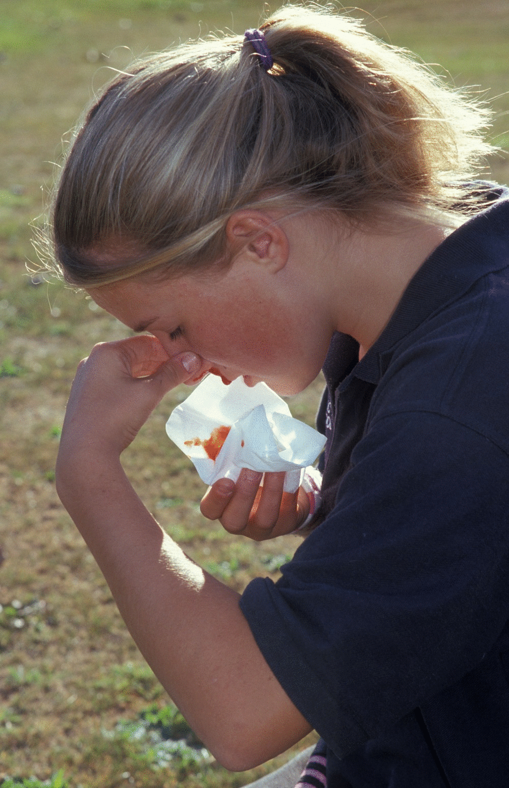 Nosebleeds Causes Treatments And Prevention Healthdirect