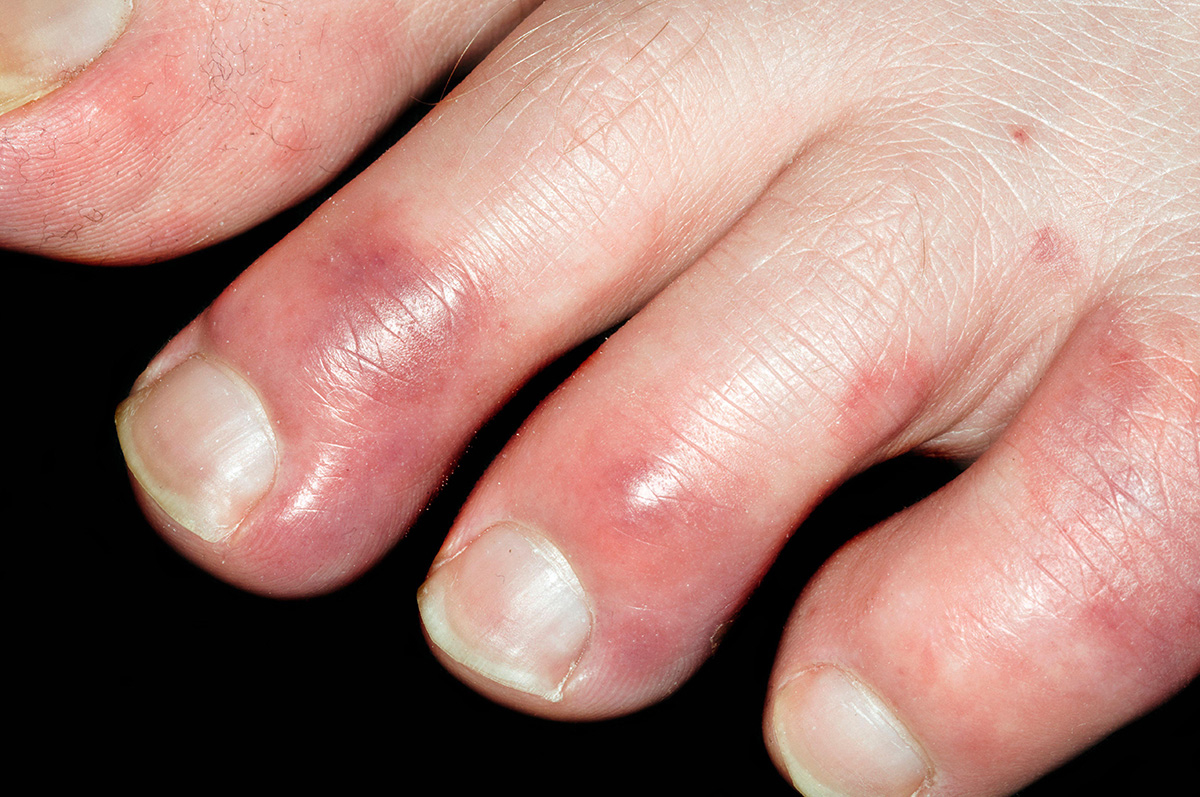 lupus pernio fingers