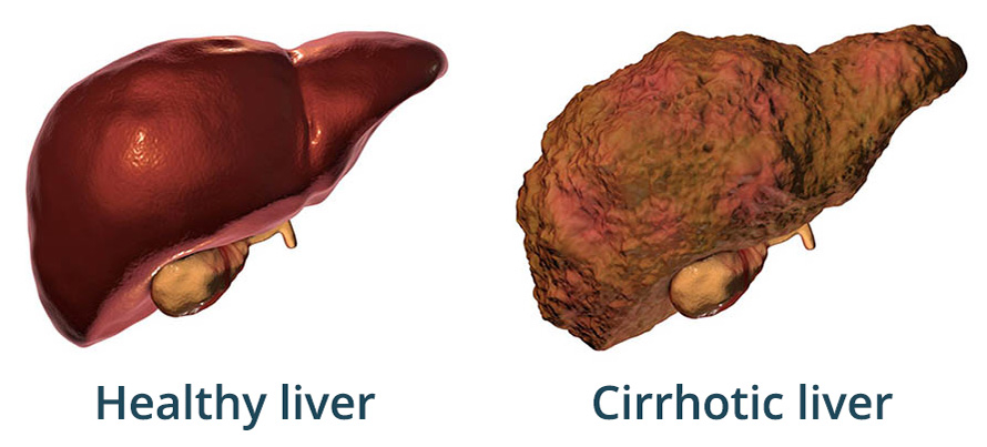 Illustration showing a comparison between a healthy liver and a liver with cirrhosis.