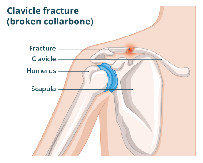 Illustration showing a clavicle fracture.