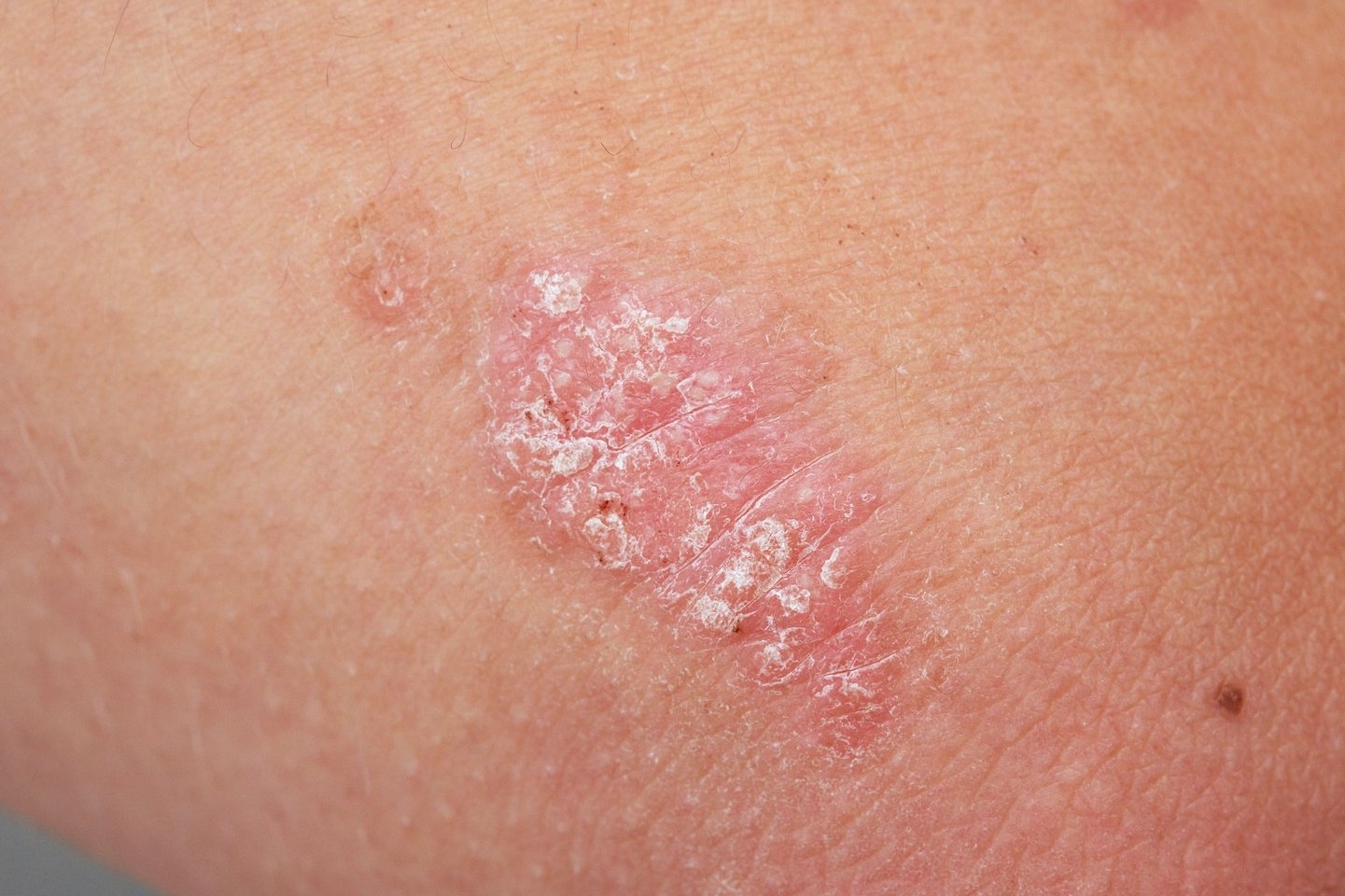 Close-up image of psoriasis on skin.