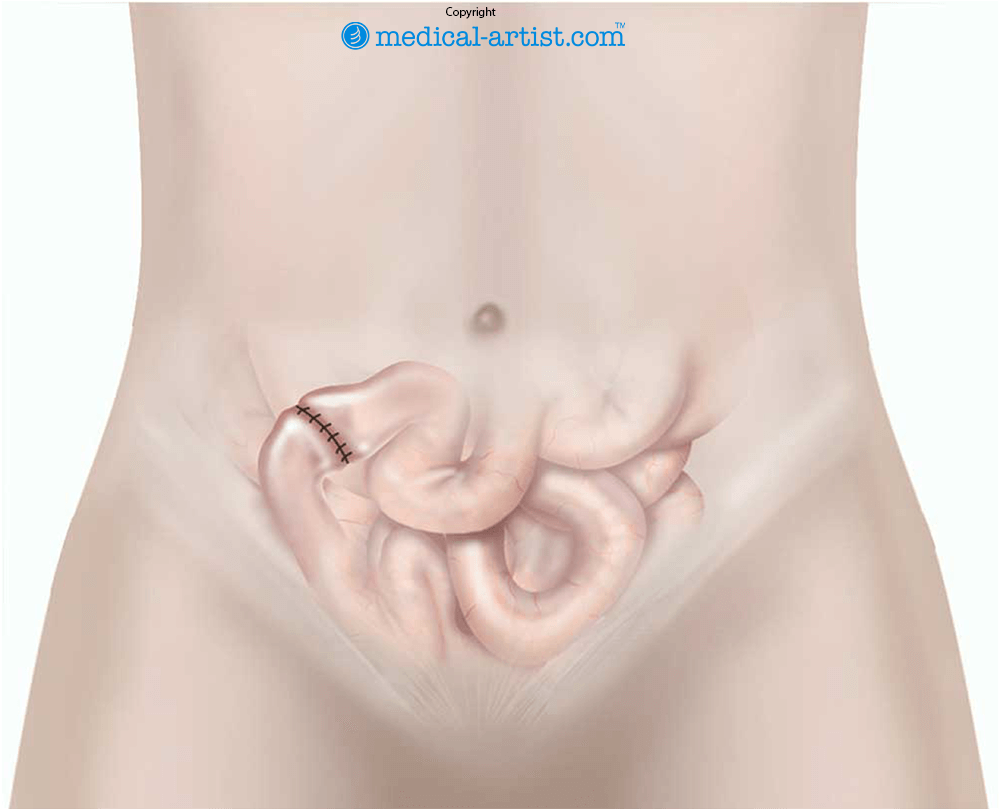 Illustration showing closure of a loop ileostomy.