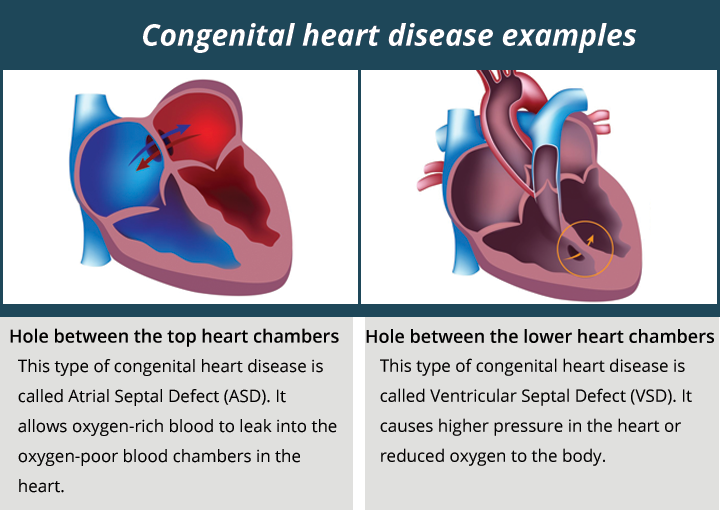 congenital heart defects symptoms