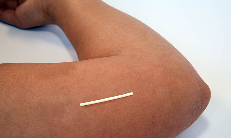 Implant Contraception