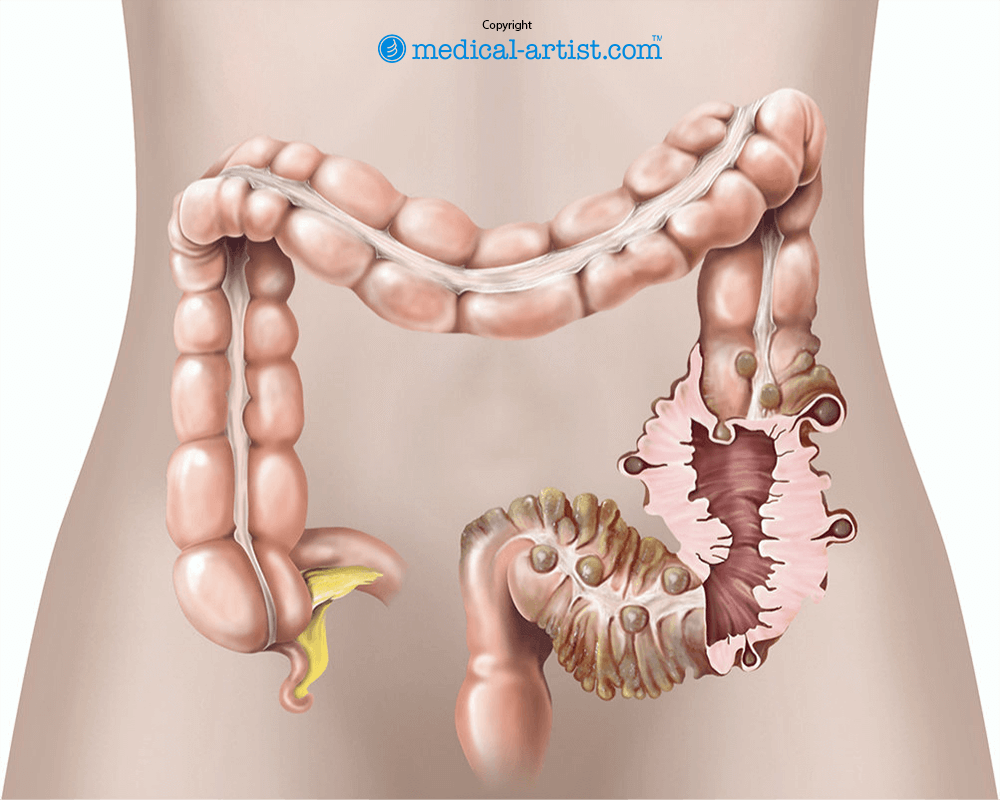 Illustration showing surgery for diverticular disease
